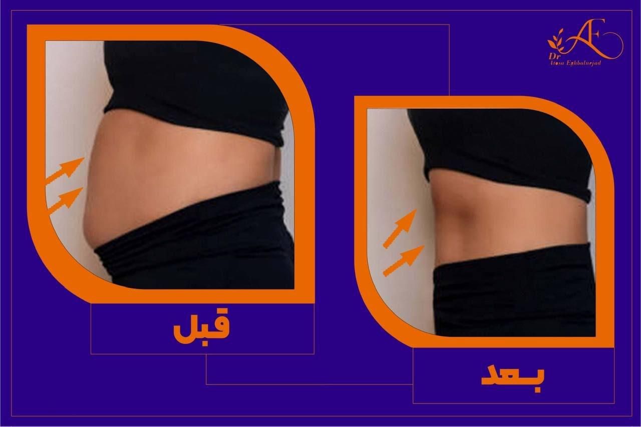 لاغری موضعی بدون جراحی و رژیم سخت|خدمات آرایشگری و زیبایی|اصفهان, سعادت‌آباد|دیوار