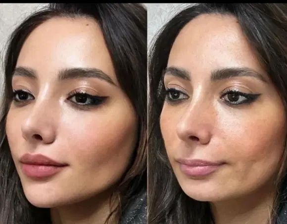 تزریق ژل بوتاکس و ساکشن تزریق چربی درکلینیک|خدمات آرایشگری و زیبایی|کرمانشاه, |دیوار