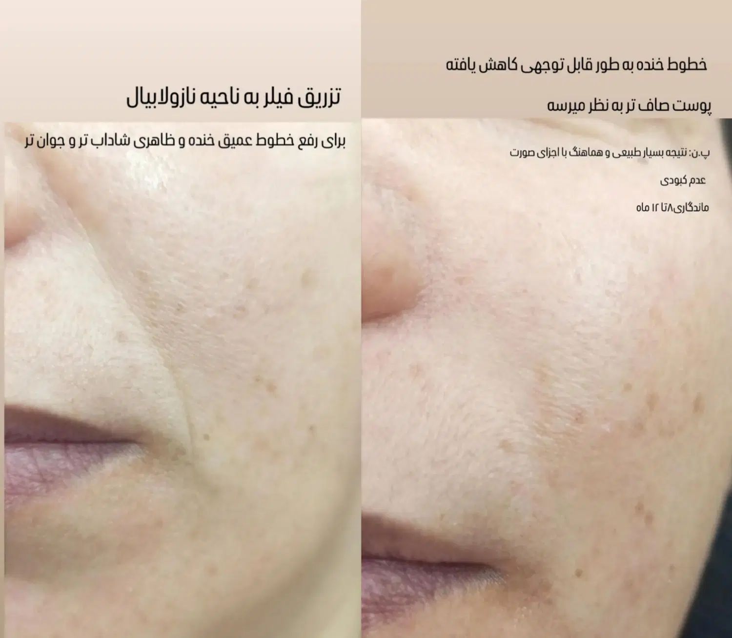 زیبایی ماندگار آرایش دائم / تزریق ژل و بوتاکس|خدمات آرایشگری و زیبایی|شوشتر, |دیوار
