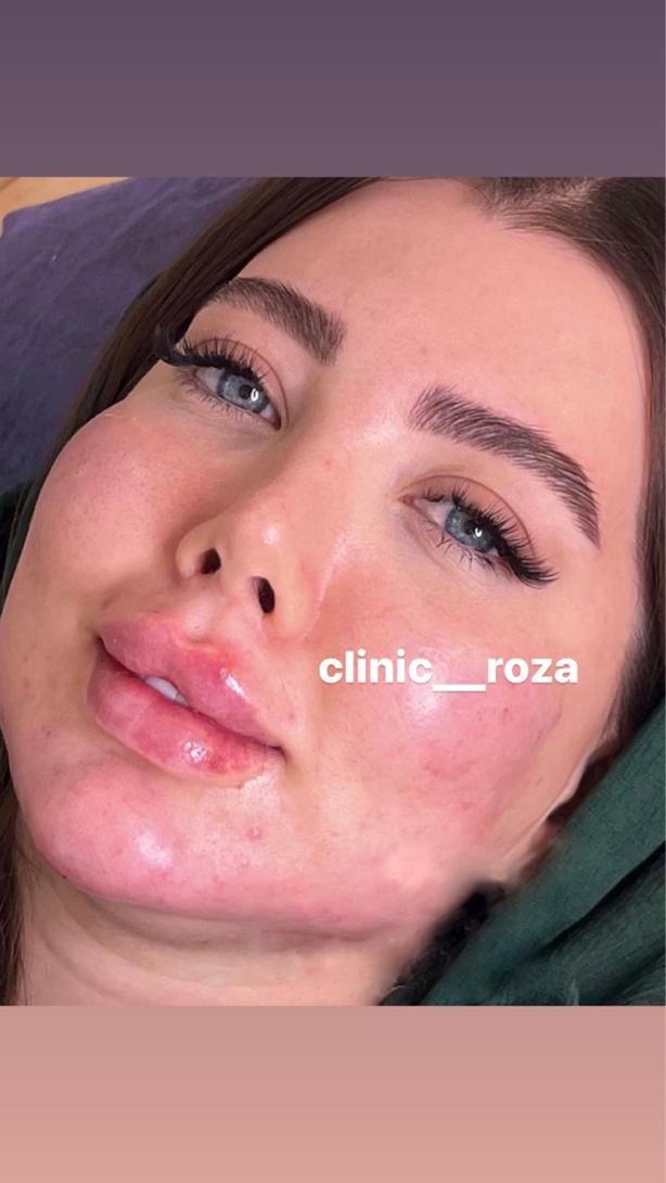 مدل تزریق ژل فیلر کانتورینگ عربی لب روسی|خدمات آرایشگری و زیبایی|کرج, گوهردشت|دیوار