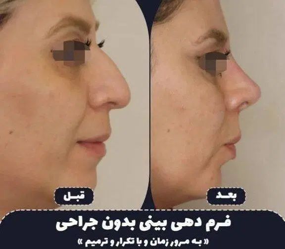 60%تخفیف لیفت صورت.وانجام لیفت بایشترین تعدادنخ|خدمات آرایشگری و زیبایی|مشهد, نیروی هوایی|دیوار