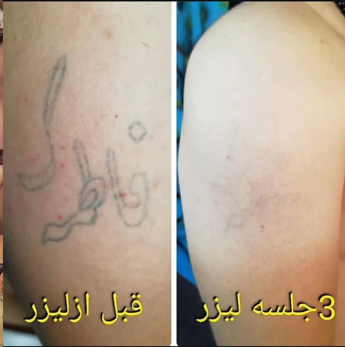 ریمو تتو.کربن ترابی صورت.روشنکردن نواحی تیره|خدمات آرایشگری و زیبایی|قم, باجک دو|دیوار