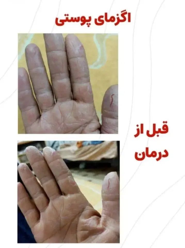 درمان پسوریازیس یا صدفک با گیاهان درمانی|آرایشی، بهداشتی، درمانی|اهواز, دانشگاه چمران|دیوار