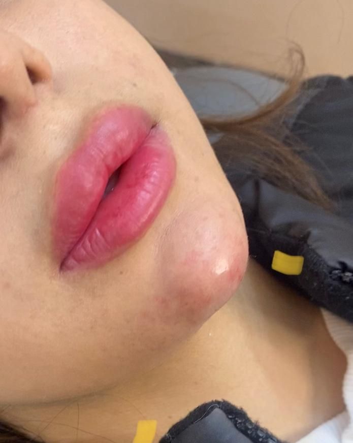 ژل لب متود روسی توسط پزشک حرفه ای|خدمات آرایشگری و زیبایی|حمیدیا, |دیوار