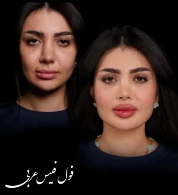 تزریق ژل لب و گونه و چانه.. (جشنواره)درمطب فقط599ت|خدمات آرایشگری و زیبایی|اصفهان, باغ زیار|دیوار