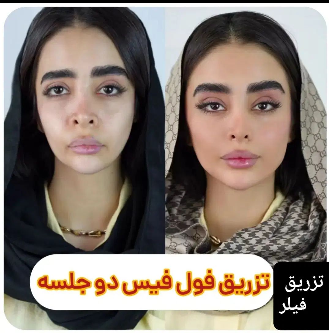 برداشتن خال۱۰ هزار تومن دریک جلسه،فیلر۳۹۰،جوانسازی|خدمات آرایشگری و زیبایی|کرج, گوهردشت|دیوار