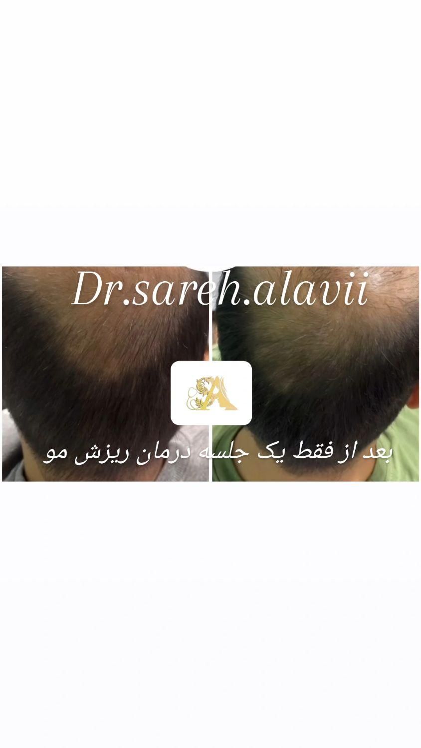درمان ریزش مو توسط پزشک|خدمات آرایشگری و زیبایی|قم, دورشهر|دیوار