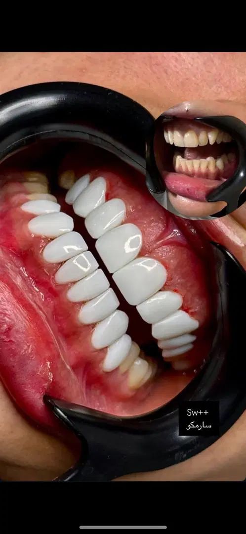 کامپوزیت و بلیچینگ با قیمت مناسب و کیفیت بالا|خدمات آرایشگری و زیبایی|اصفهان, سروستان|دیوار