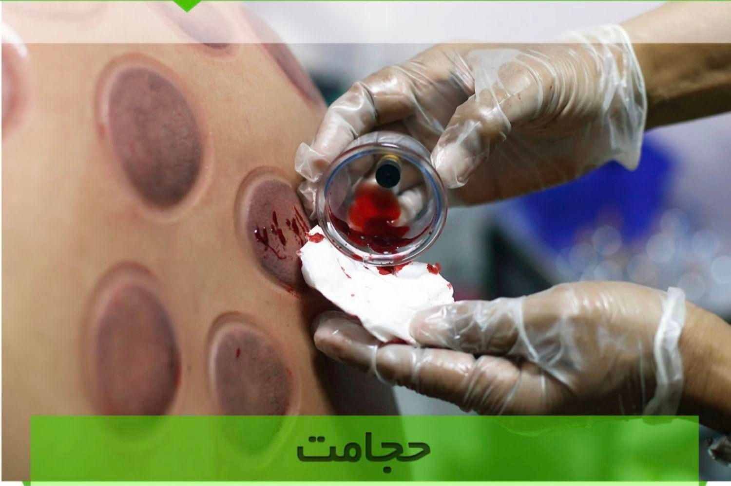 حجامت وفصد خون درمنزل در قرچک   پذیرفته میشود|خدمات آرایشگری و زیبایی|قرچک, |دیوار