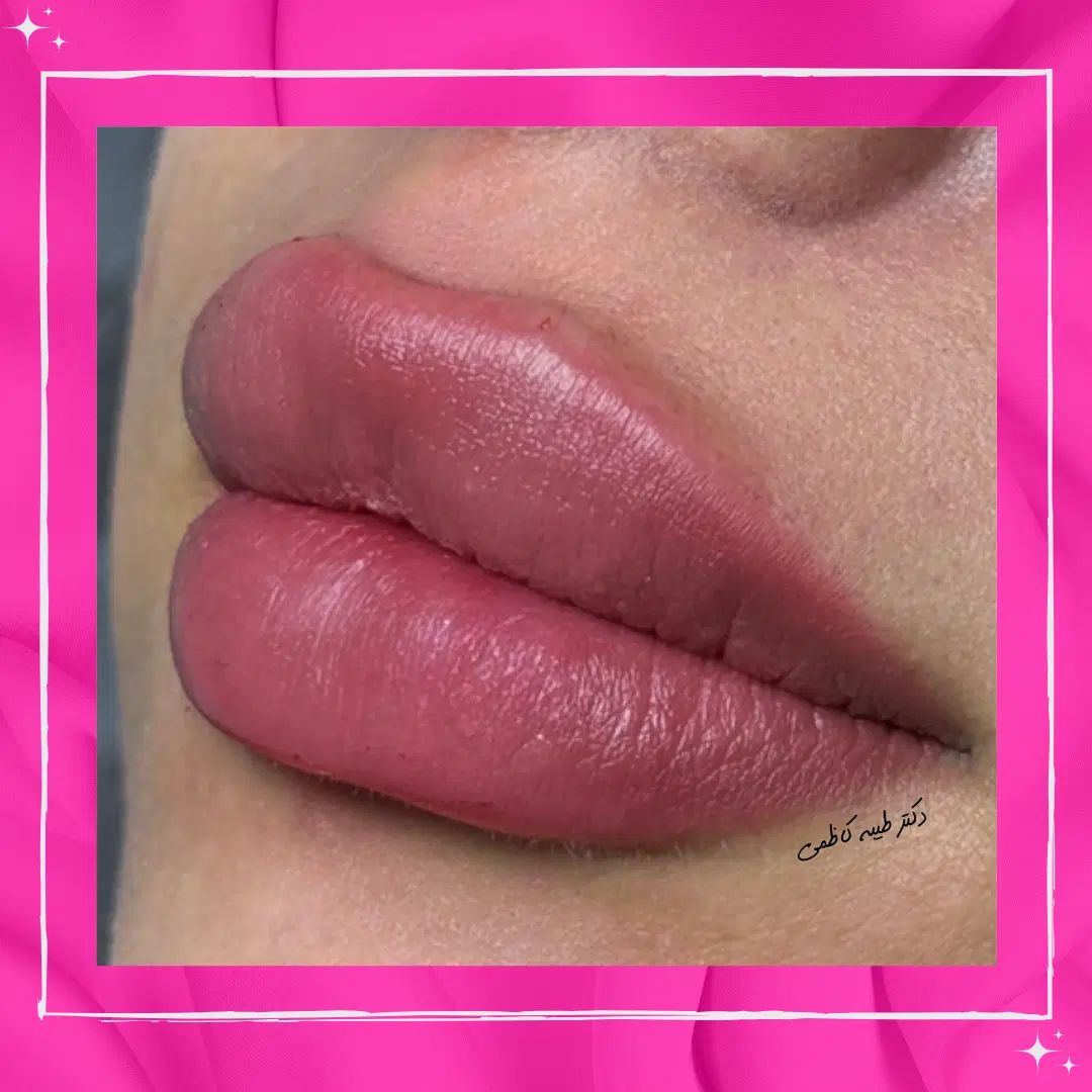 تخفیفات 50% دکتر کاظمی، بوتاکس فیلر مزو ژل لب روسی|خدمات آرایشگری و زیبایی|مشهد, احمدآباد|دیوار