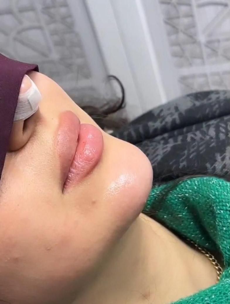 ژل بوتاکس مزوتراپی prp با قیمت استثنائی توسط پزشک|خدمات آرایشگری و زیبایی|اسلام‌شهر, باغ فیض|دیوار