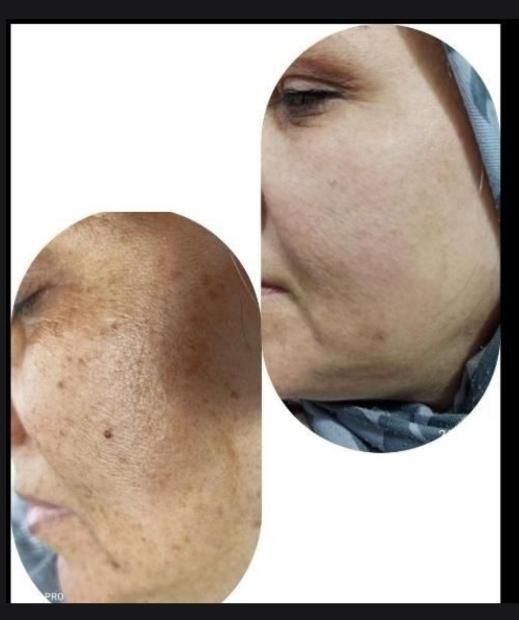 ازبین بردن کک ومک تضمینی در یک جلسه|خدمات آرایشگری و زیبایی|گالیکش, |دیوار