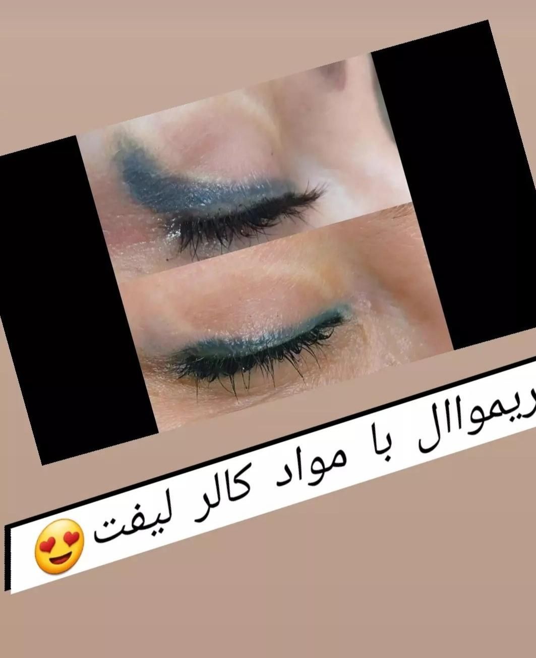 ریموو تتو با مواد آمریکایی تضمین سلامت پوست|خدمات آرایشگری و زیبایی|همدان, |دیوار