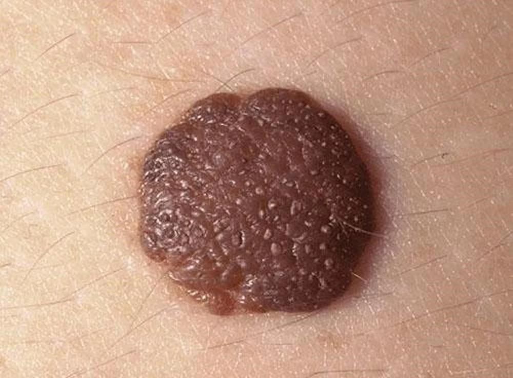 برداشتن خال زگیل گوشت اضاف برداشت زگیل تناسلی|خدمات آرایشگری و زیبایی|شیراز, معالی‌آباد|دیوار