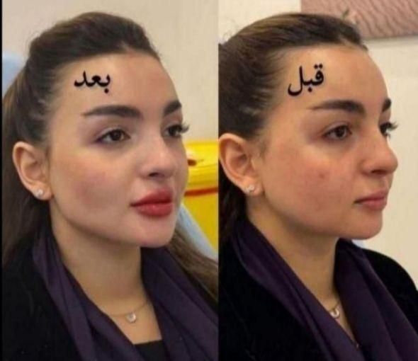 ژل بوتاکس فیلر چشم زاویه فک گونه چانه فشیال بیکینی|خدمات آرایشگری و زیبایی|قم, زنبیل آباد|دیوار