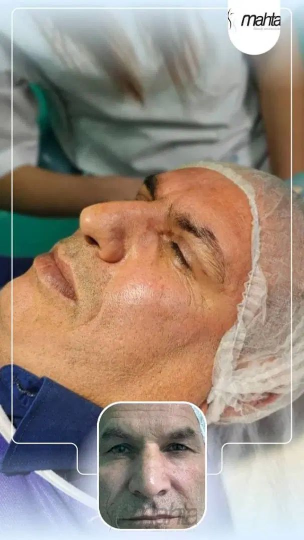 بلفارو پلاستی ( جراحی افتادگی پلک)آقایان و بانوان|خدمات آرایشگری و زیبایی|تهران, تهرانسر مرکزی|دیوار