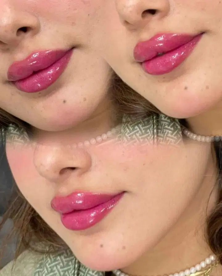 فیلرژل لب چونه گونه زاویه فک..توسط پیراپزشک|خدمات آرایشگری و زیبایی|زاهدان, |دیوار