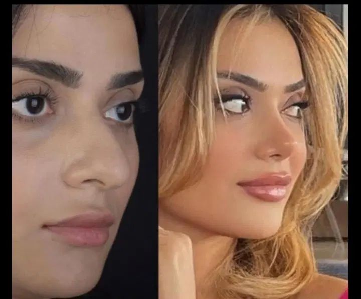 عمل جراحی بینی وترمیم باپیزو/لیفت صورت وپلک|خدمات آرایشگری و زیبایی|کرج, چهارصد دستگاه|دیوار