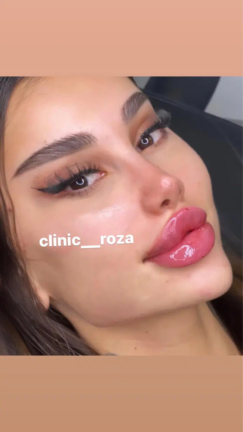 مدل تزریق ژل و بوتاکس کانتورینگ عربی ،لب روسی|خدمات آرایشگری و زیبایی|کرج, گوهردشت|دیوار