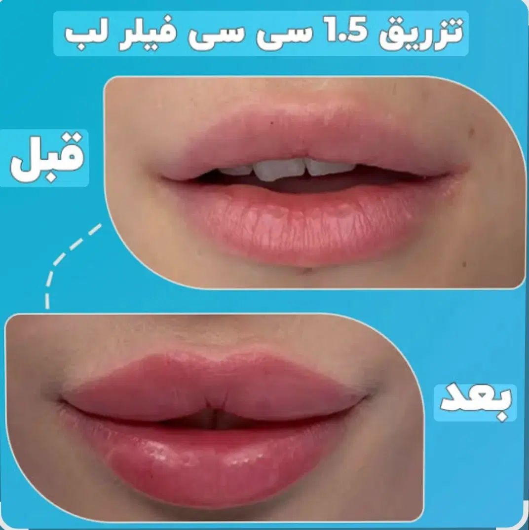 50٪تخفیف خدمات فیلر بوتاکس مزوتراپی پرسینگ چال لپ|خدمات آرایشگری و زیبایی|اصفهان, مولوی|دیوار