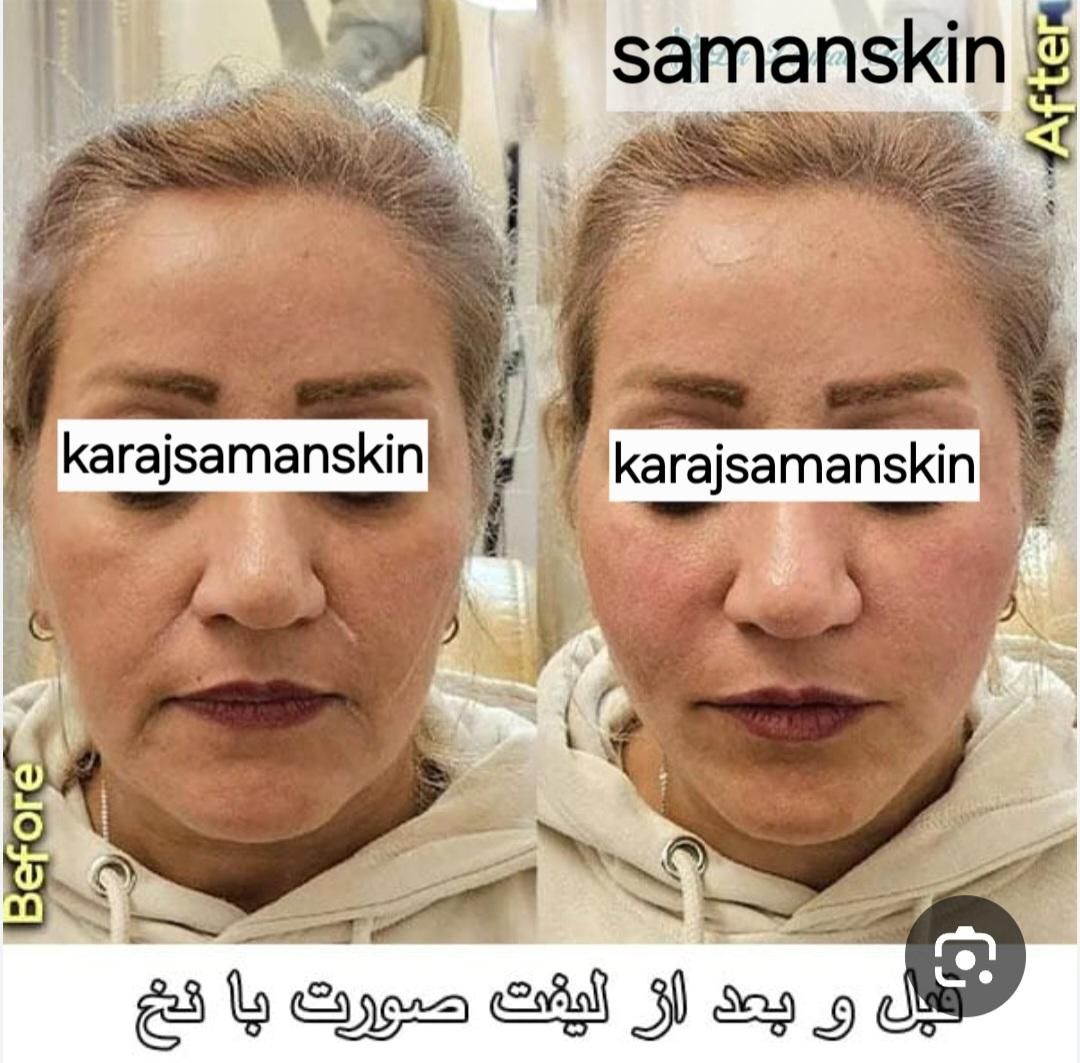 جشنواره مرکز تزریق چربی صورت ،ژل ،بوتاکس.prp|خدمات آرایشگری و زیبایی|کرج, اصفهانیها|دیوار