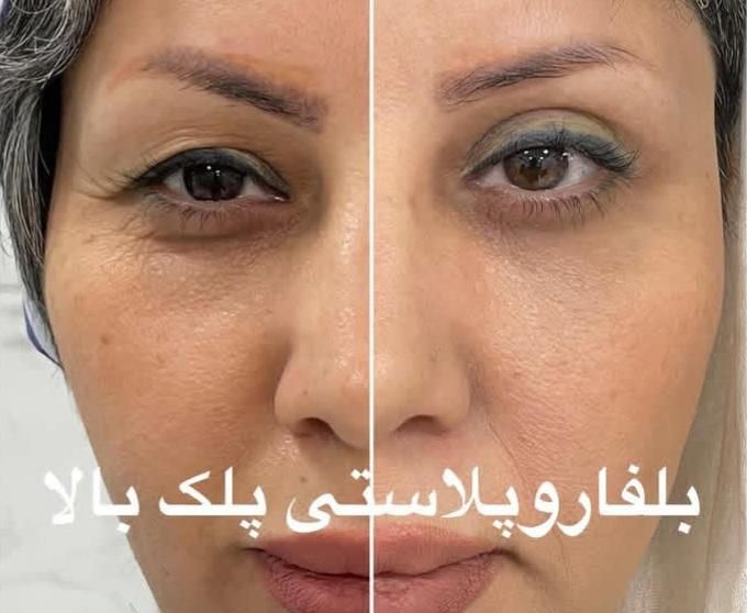 تزریق چربی فیلر کانتورینگ بوتاکس نخ لیفت مزوتراپی|خدمات آرایشگری و زیبایی|اصفهان, بوستان آینه خانه|دیوار