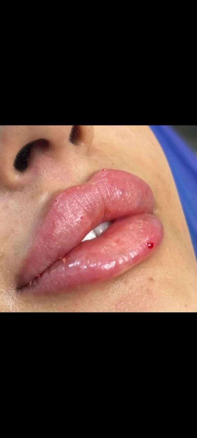 تزریق ژل و بوتاکس|خدمات آرایشگری و زیبایی|بیرجند, |دیوار