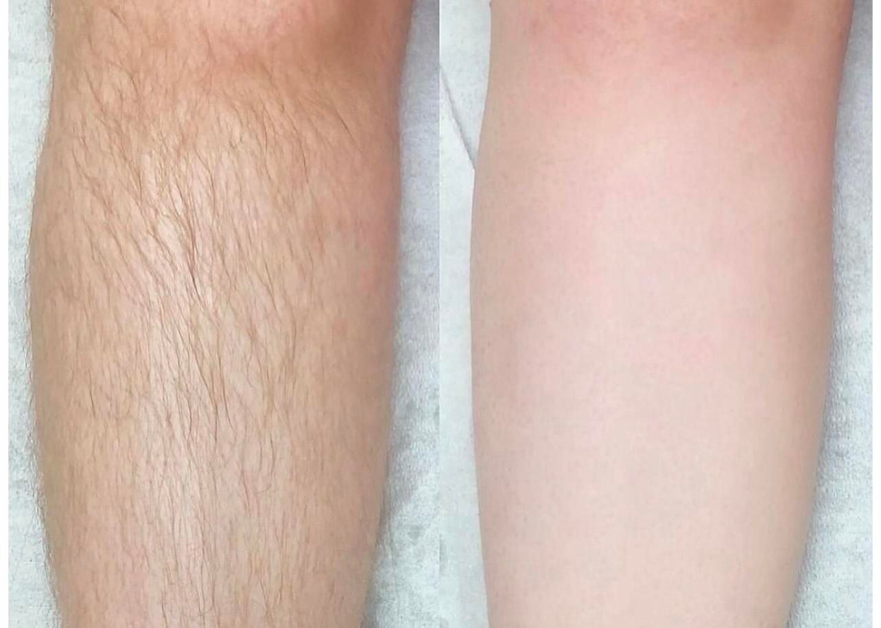 کلینیک لیزر موهای زائد|خدمات آرایشگری و زیبایی|خمینیشهر, |دیوار