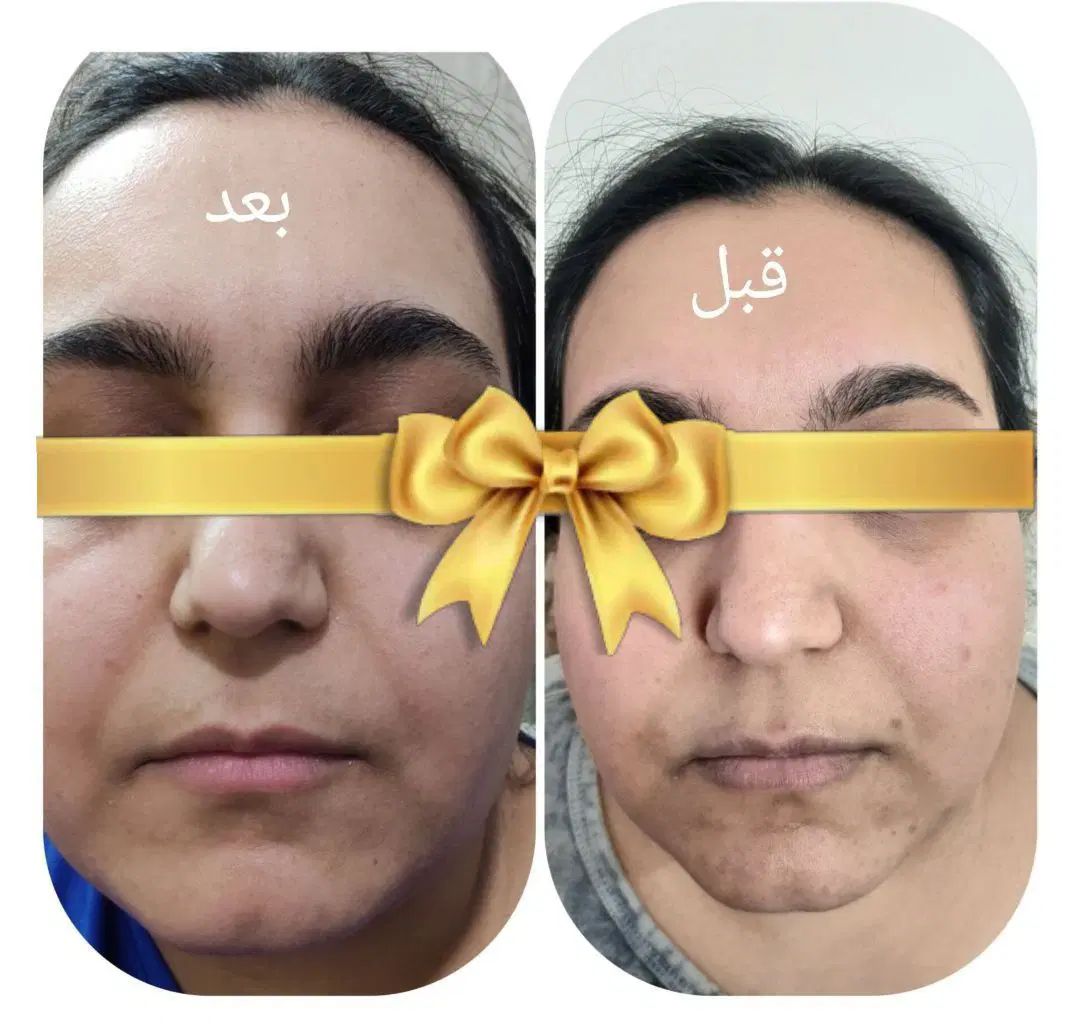 سرم جوانساز پوست صورت آریا|آرایشی، بهداشتی، درمانی|اصفهان, کوی امیریه|دیوار