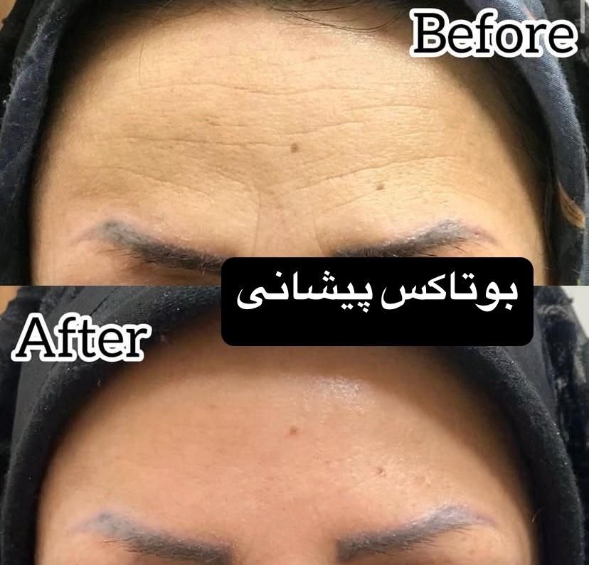 بوتاکس توسط پزشک جهت رفع چین و چروک و لیفت ابرو|خدمات آرایشگری و زیبایی|یزد, |دیوار