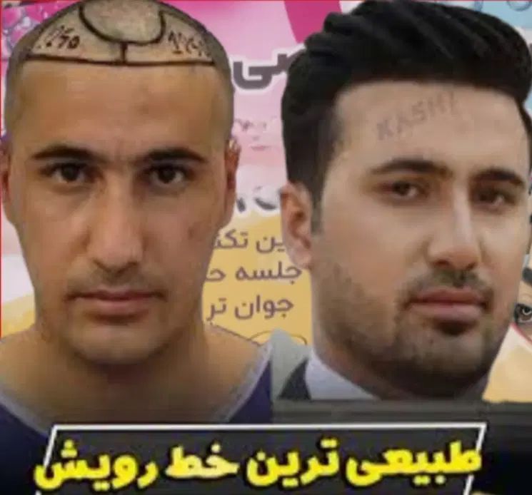 کاشت موکاشت ابرو+ اموزش کاشت مو نقد، اقساط تضمینی|خدمات آرایشگری و زیبایی|شیراز, عفیف‌آباد|دیوار