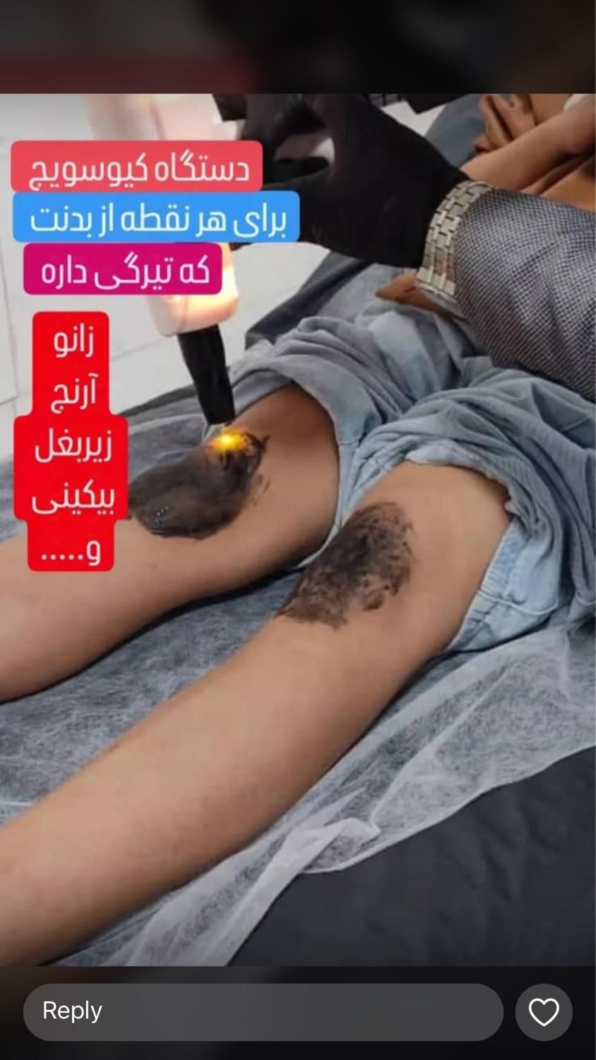 پاک کردن انواع تتو لاغری موضعی لیزر موهای زاید|خدمات آرایشگری و زیبایی|شیراز, حافظیه|دیوار