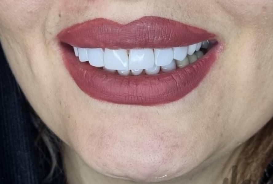 دندان مصنوعی|خدمات آرایشگری و زیبایی|اردبیل, |دیوار