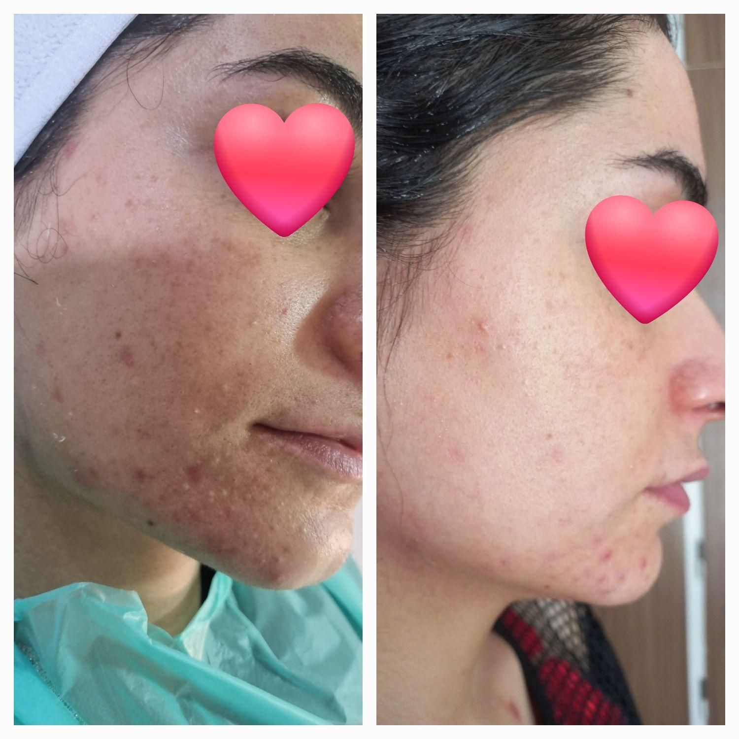 پاکسازی فوق تخصصی و درمانی پوست بانوان|خدمات آرایشگری و زیبایی|مرودشت, پشت سایپا‎|دیوار