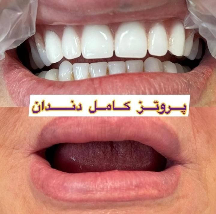 فلکسیبل دَندان مَصنوعی تکه ای ژله ای دَنداًنسازی|خدمات آرایشگری و زیبایی|یزد, |دیوار
