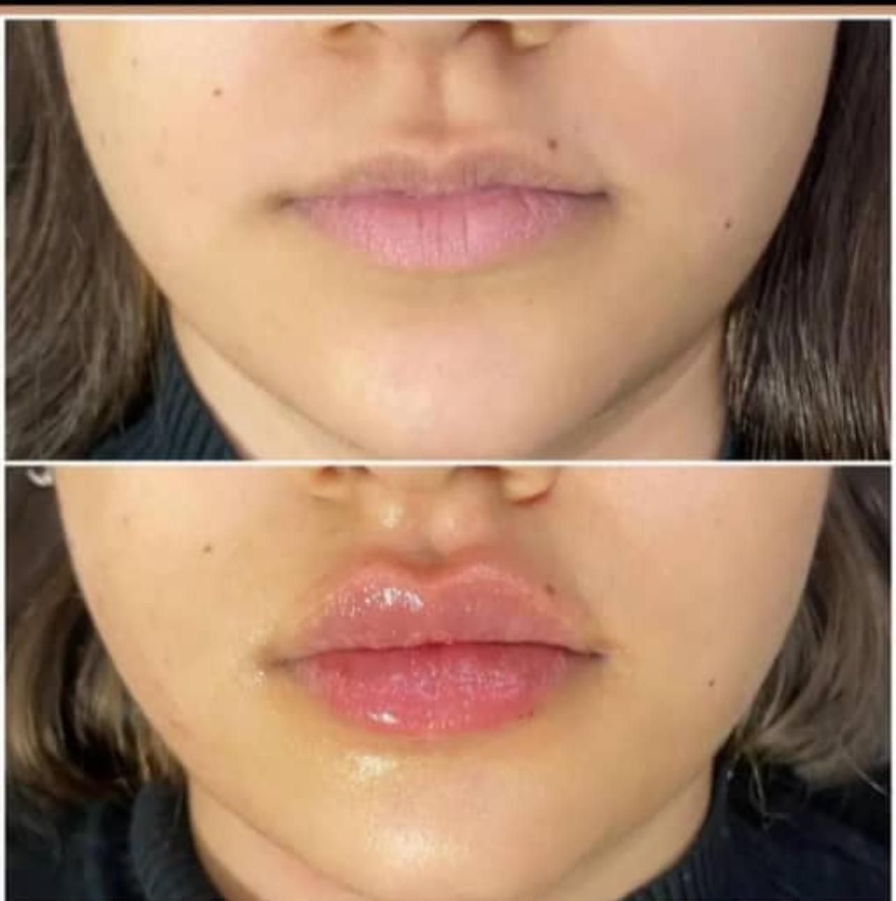 اف ویژه ژل بوتاکس بندرعباس|خدمات آرایشگری و زیبایی|بندرعباس, |دیوار