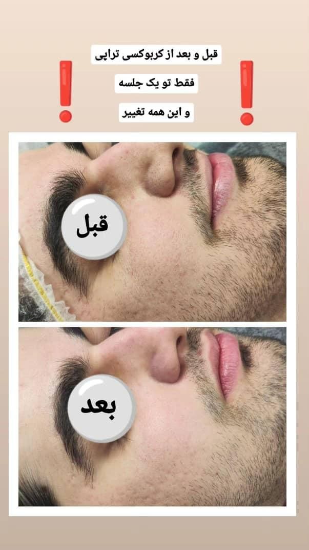 فیشیال تخصصی/پاکسازی پوست/ اسکین کر/پیلینگ شیمیایی|خدمات آرایشگری و زیبایی|شیراز, زند|دیوار