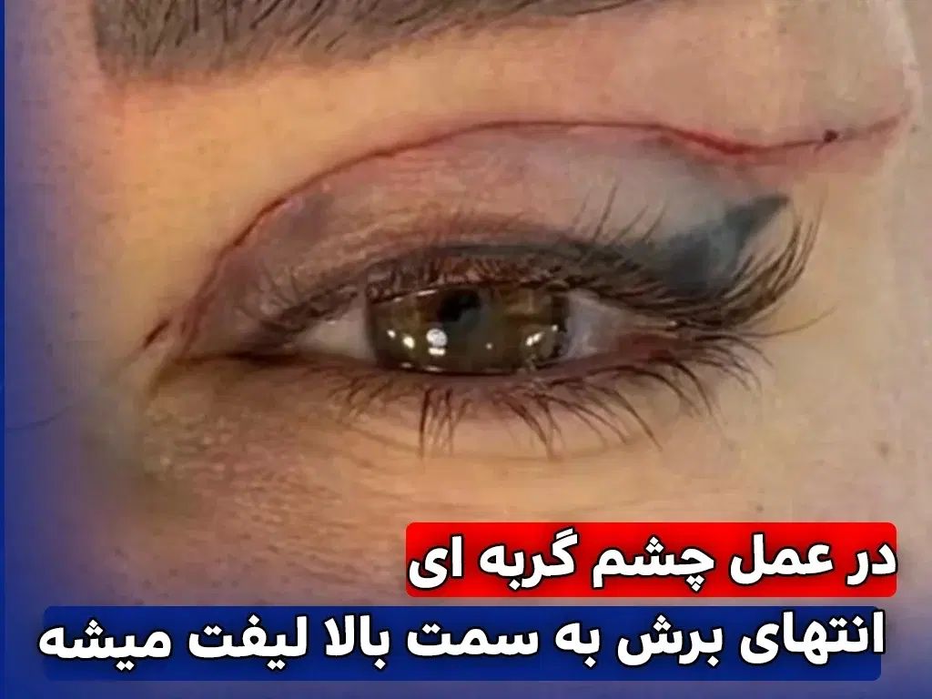 جراحی بلفاروپلاستی(رفع افتادگی پلک)بوکال فت/ساکشن|خدمات آرایشگری و زیبایی|تهران, هفت حوض|دیوار