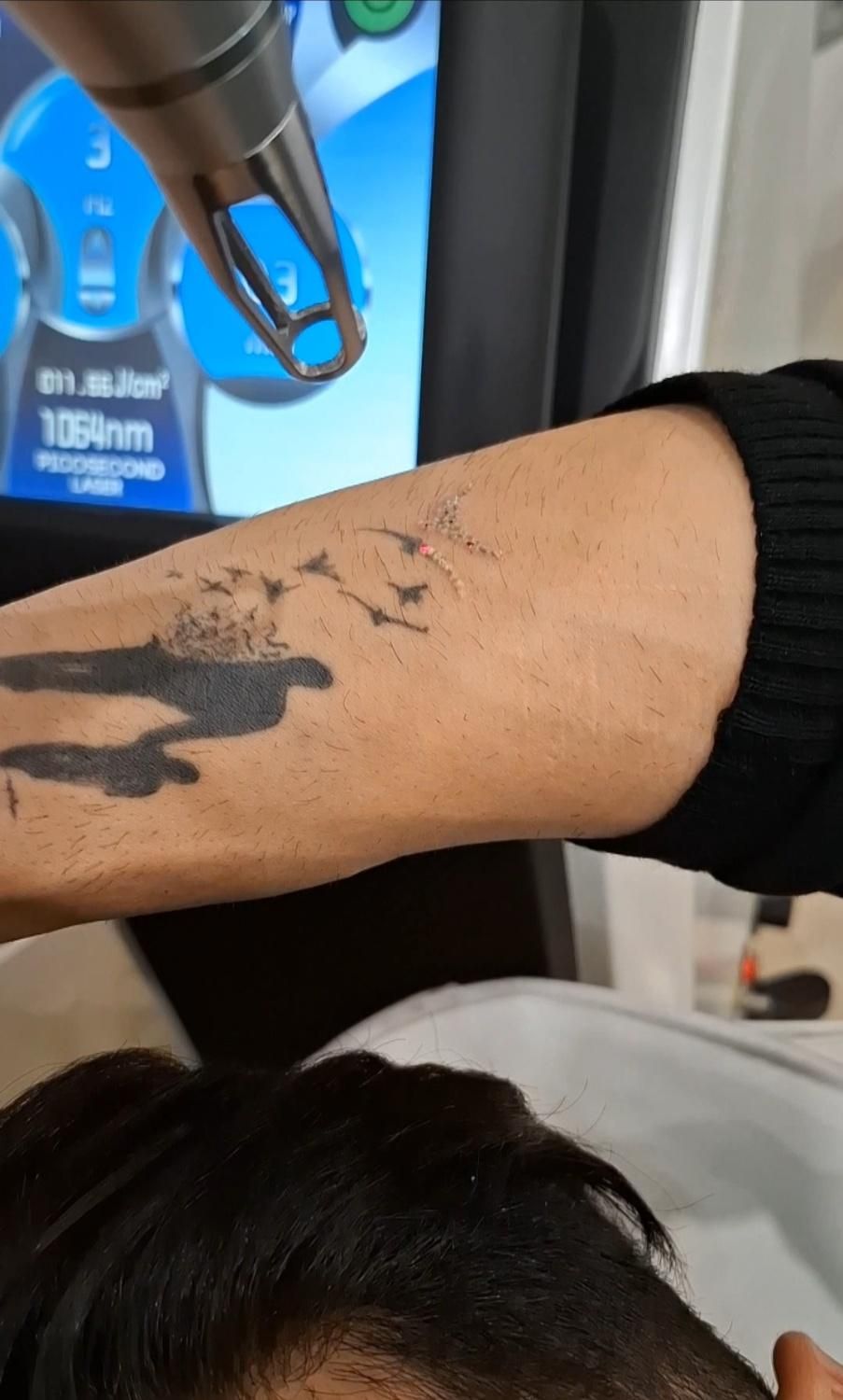 پاک کردن تاتو بدون درد با دستگاه کیوسوئیچ پیکوسکند|خدمات آرایشگری و زیبایی|ساری, |دیوار