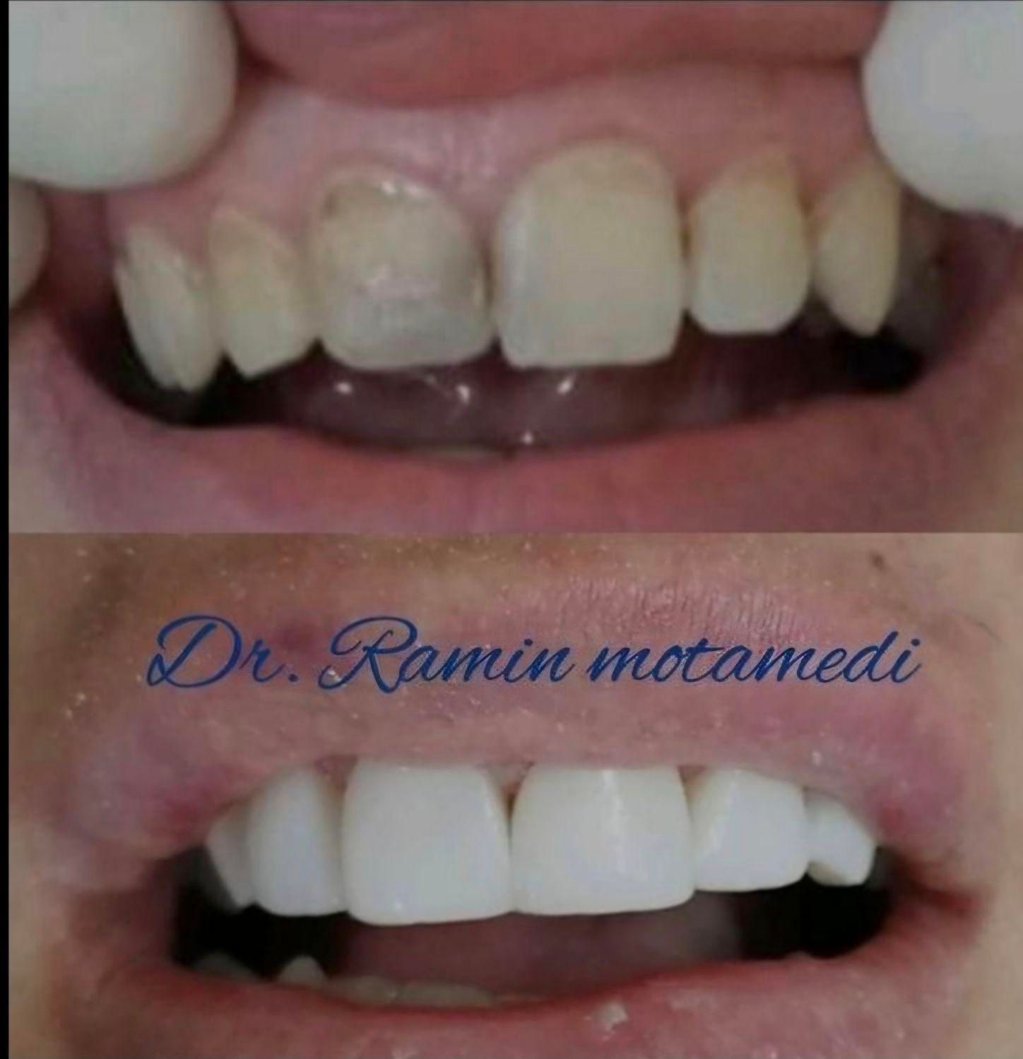 ایمپلنت/کامپوزیت/دندانپزشکی/اقساط|خدمات آرایشگری و زیبایی|شیرگاه, |دیوار