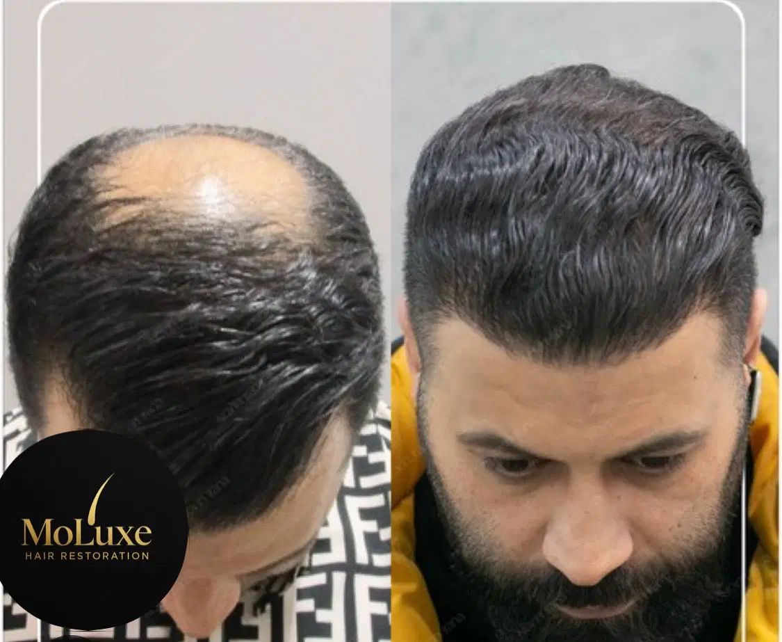کاشت مو، ریش و ابرو با جدیدترین متد روز دنیا|خدمات آرایشگری و زیبایی|شیراز, عفیف‌آباد|دیوار