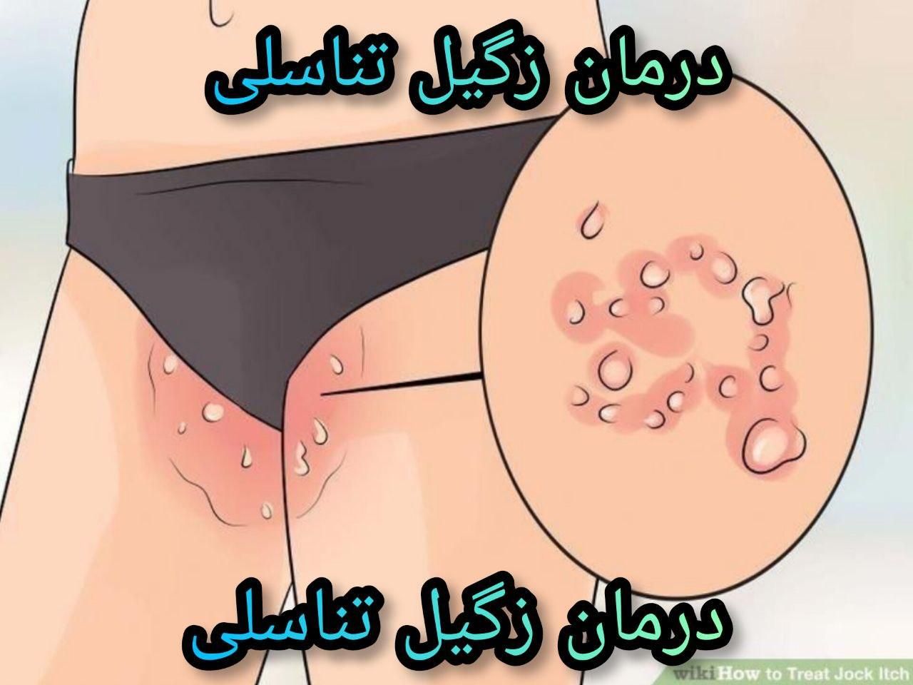 درمان زگیل تناسلی/ مشاوره Hpv|آرایشی، بهداشتی، درمانی|تهران, فرمانیه|دیوار