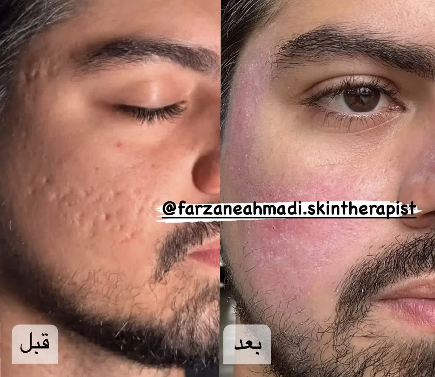 درمان کک ومک/درمان لک/درمان جوش/ردبخیه/اسکار|خدمات آرایشگری و زیبایی|قدس, شهر‌قدس|دیوار