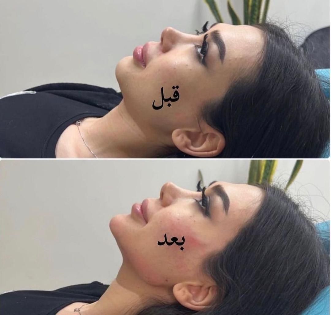 جشنواره  تزریق چربی لیزر لاغری ژل بوتاکس|خدمات آرایشگری و زیبایی|تهران, هفت حوض|دیوار