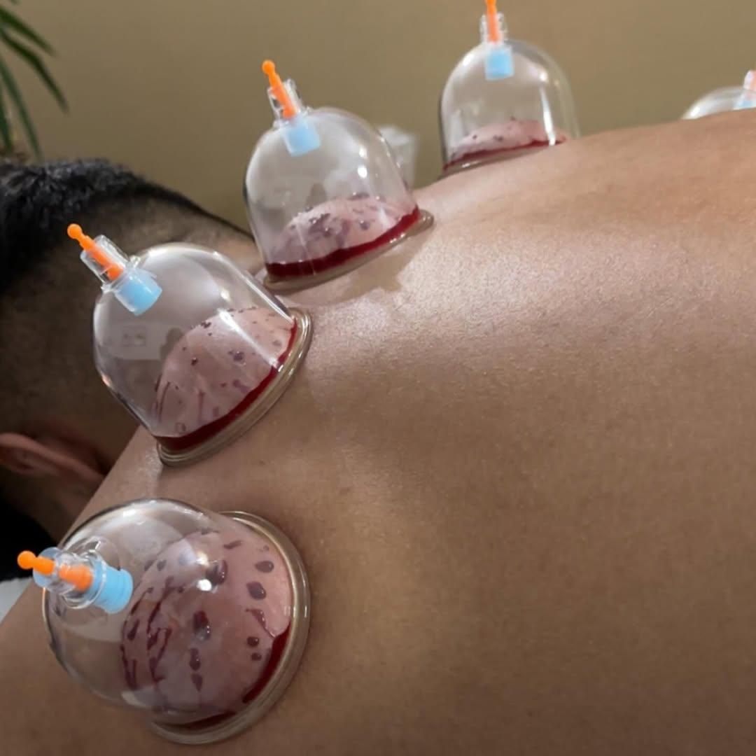 حجامت، درمان چسبندگی عصب دست، کبد چرب|خدمات آرایشگری و زیبایی|زاهدان, |دیوار