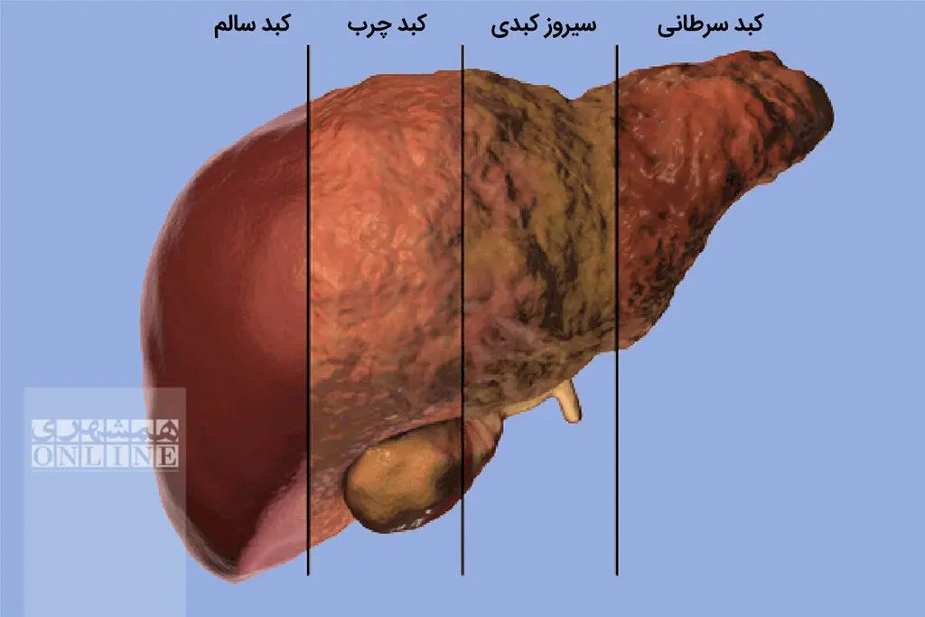 درمان تخصصی کبد چرب بدون عمل جراحی|آرایشی، بهداشتی، درمانی|تهران, جیحون|دیوار