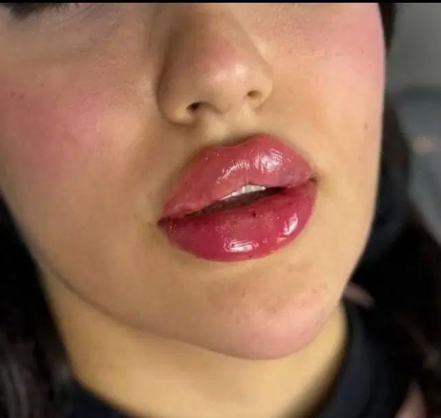 تزریق ژل لب فیلر زاویه سازی صورت فک گونه بوتاکس|خدمات آرایشگری و زیبایی|فردیس, خیام شرقی|دیوار