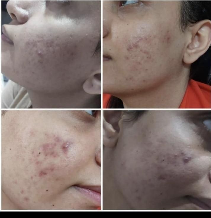 درمان جوش با هر منشایی|خدمات آرایشگری و زیبایی|دوگنبدان, |دیوار