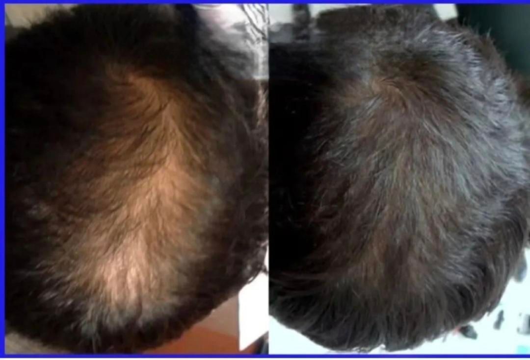 رویش مجددمو،جلوگیری ازریزش مو|خدمات آرایشگری و زیبایی|گنبد کاووس, |دیوار