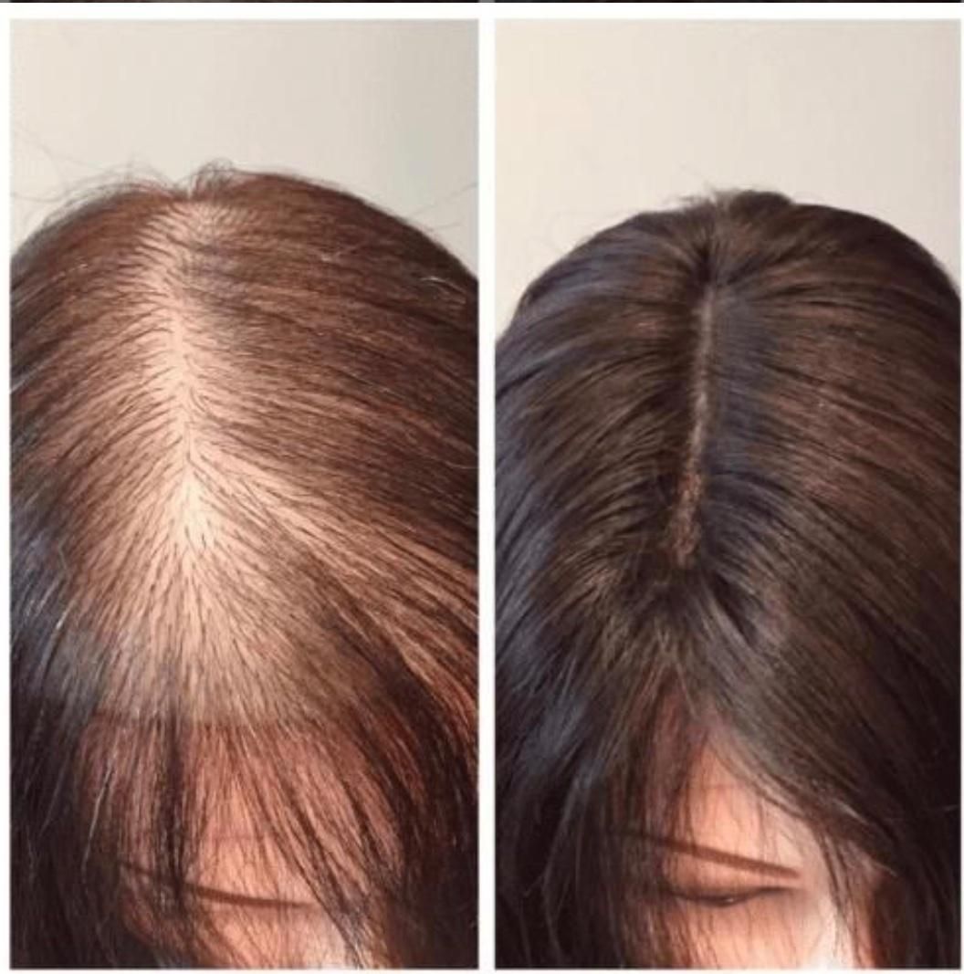 باریزش موخداحافظی کن|آرایشی، بهداشتی، درمانی|گنبد کاووس, |دیوار